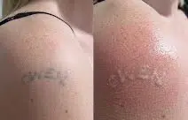 Tattoo Removal Cream Before and After Results