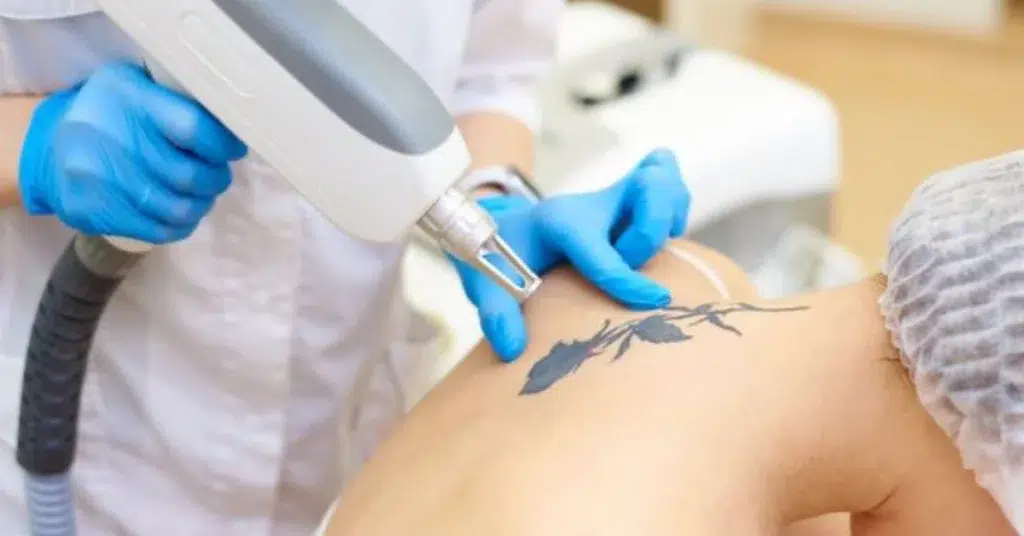 laser tattoo removal