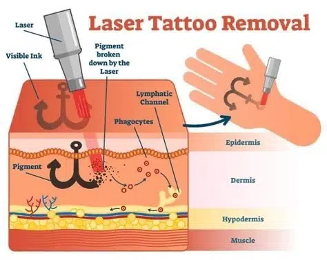 laser tattoo removal