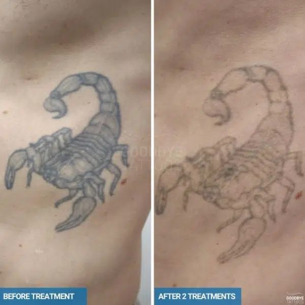 laser tattoo removal