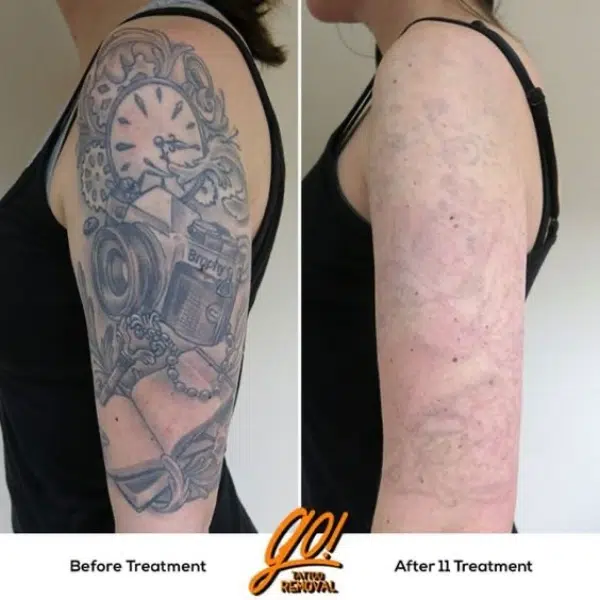 laser tattoo removal